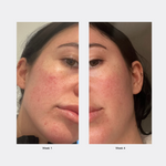 Before and after comparison of a woman's face with visible skin improvement over 4 weeks.