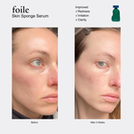 Before and after comparison of a woman's face with skin serum treatment showing reduced redness and irritation.