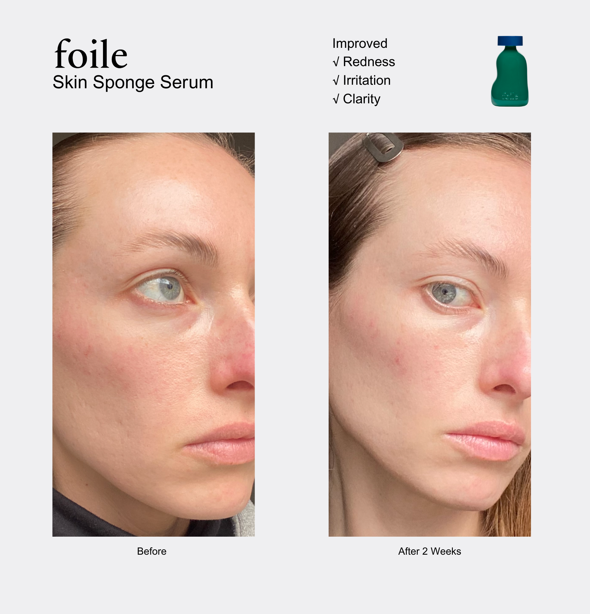 Before and after comparison of a woman's face with skin serum treatment showing reduced redness and irritation.