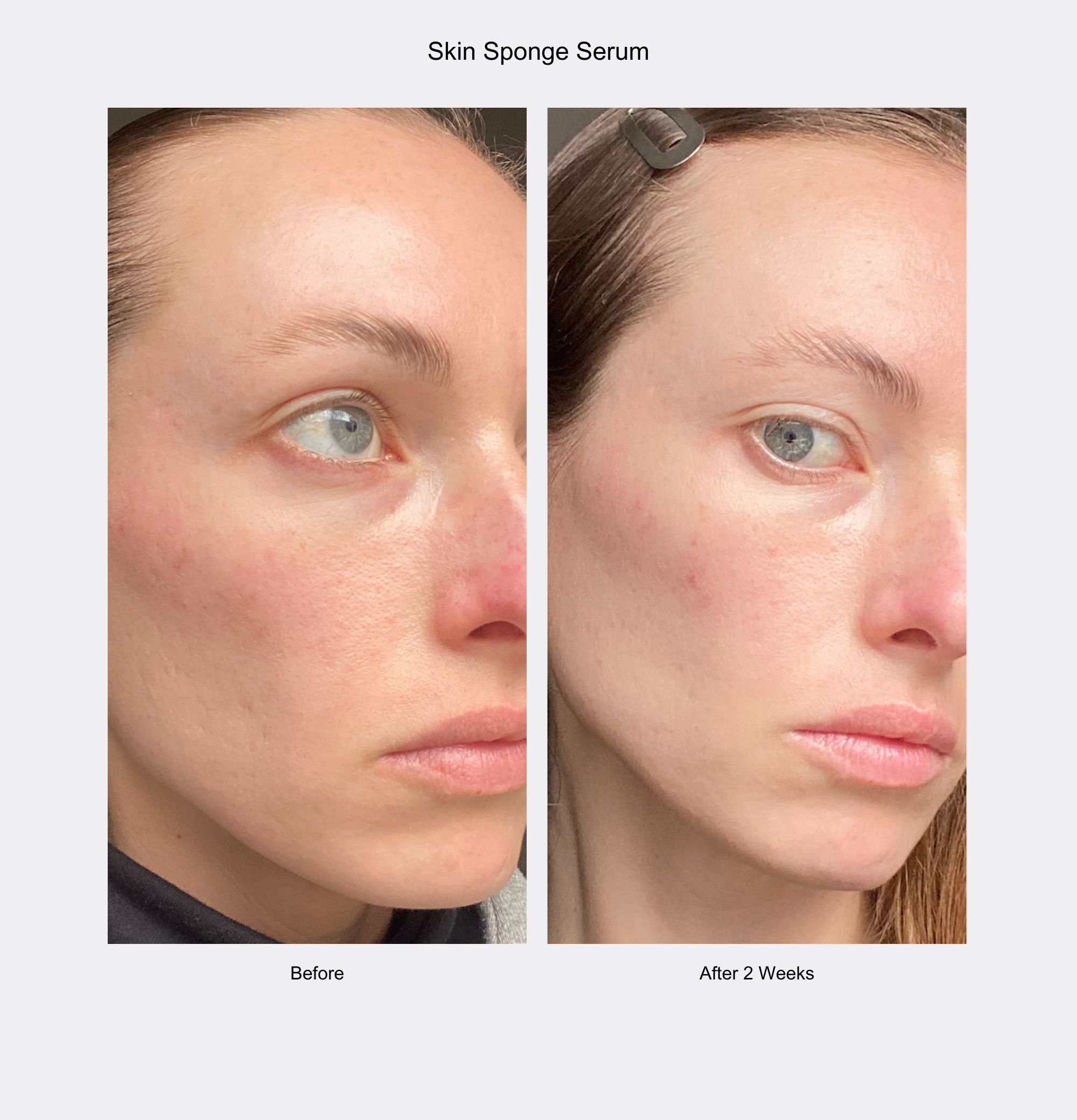 Before and after comparison of a woman's face with Skin Sponge Serum showing reduced redness.