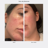 Before and after comparison of a woman's face using Daily Jelly Moisturizer.
